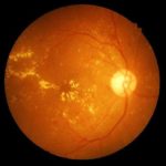 what-is-dry-macular-degeneration-722×406.jpg